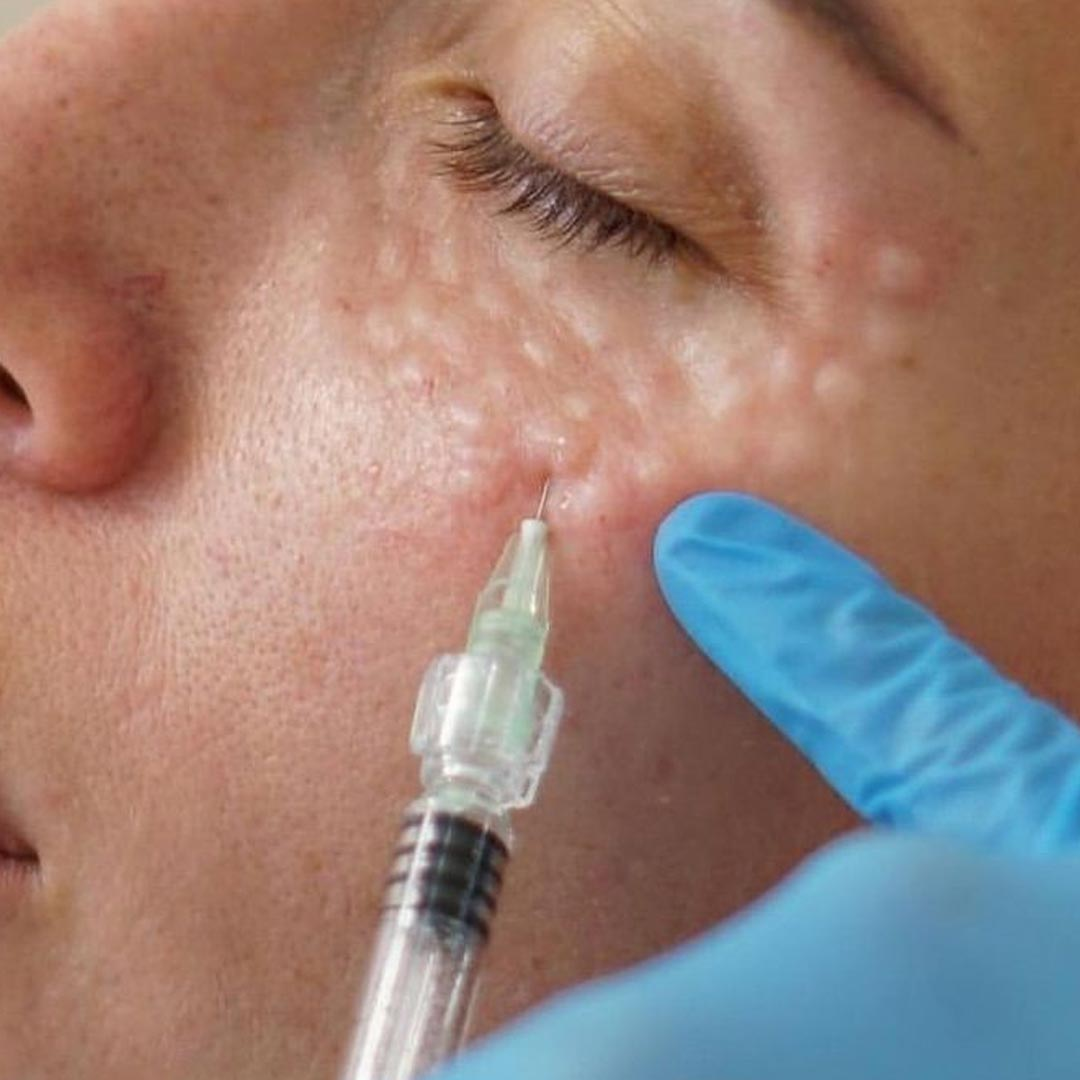 Reference image of a skin injection procedure